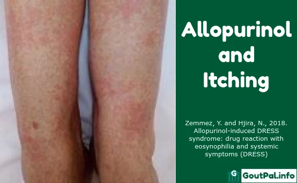 Allopurinol and Itching