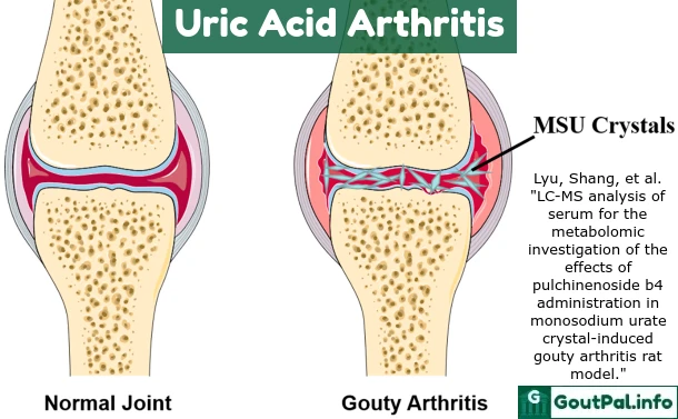 Uric Acid Arthritis