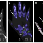 Gout Hand Images Compared