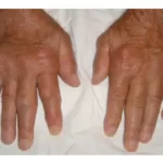 Assessing Gout Damage in Hands